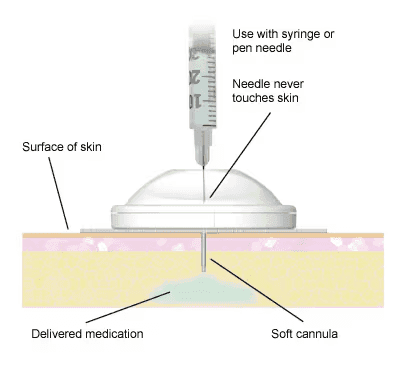 Diagram showing the i-Port Advance cross-section with a soft cannula beneath the skin and a needle entering through the port