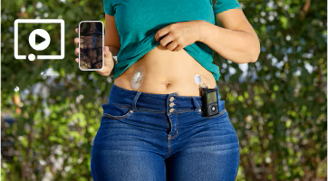 An abdomen showing the 780G insulin pump system