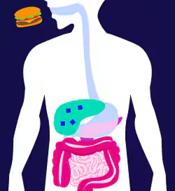 Graphic of gastroparesis