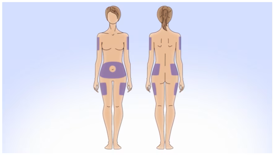 Best body areas for infusion set insertion
