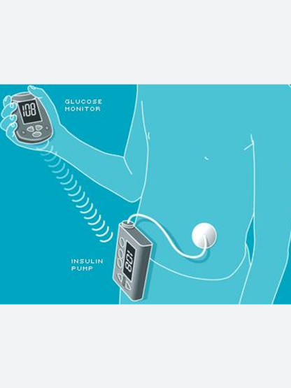 <p>2003<br />
World's first pump and CGM system</p>
