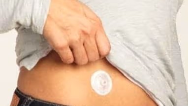 i-Port on the abdomen